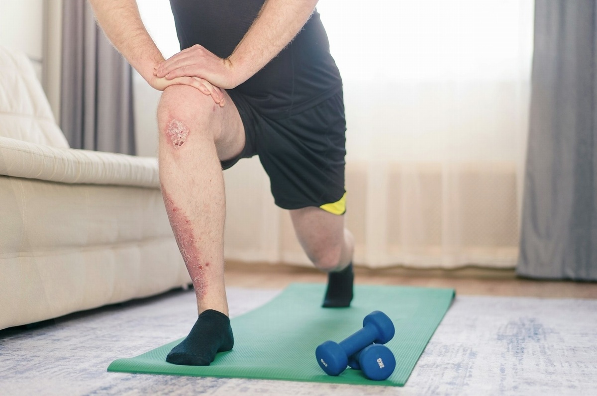 Man with psoriasis on leg does home exercises Man with psoriasis on leg does home exercises
