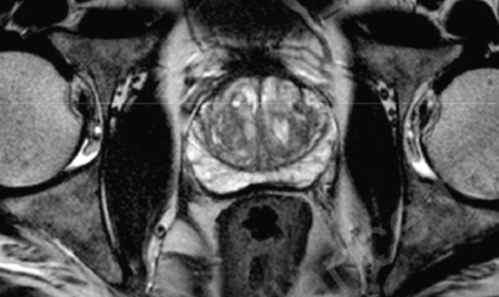 prostate_mri