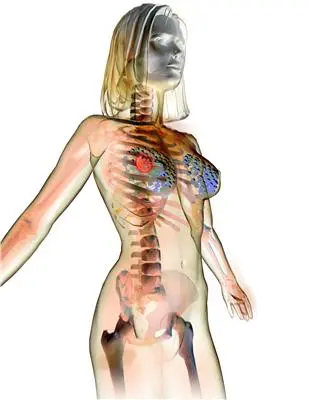 how hormone replacement therapy can increase the risk of breast cancer