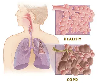 COPD Healthy Alveoli and Damaged Alveoli