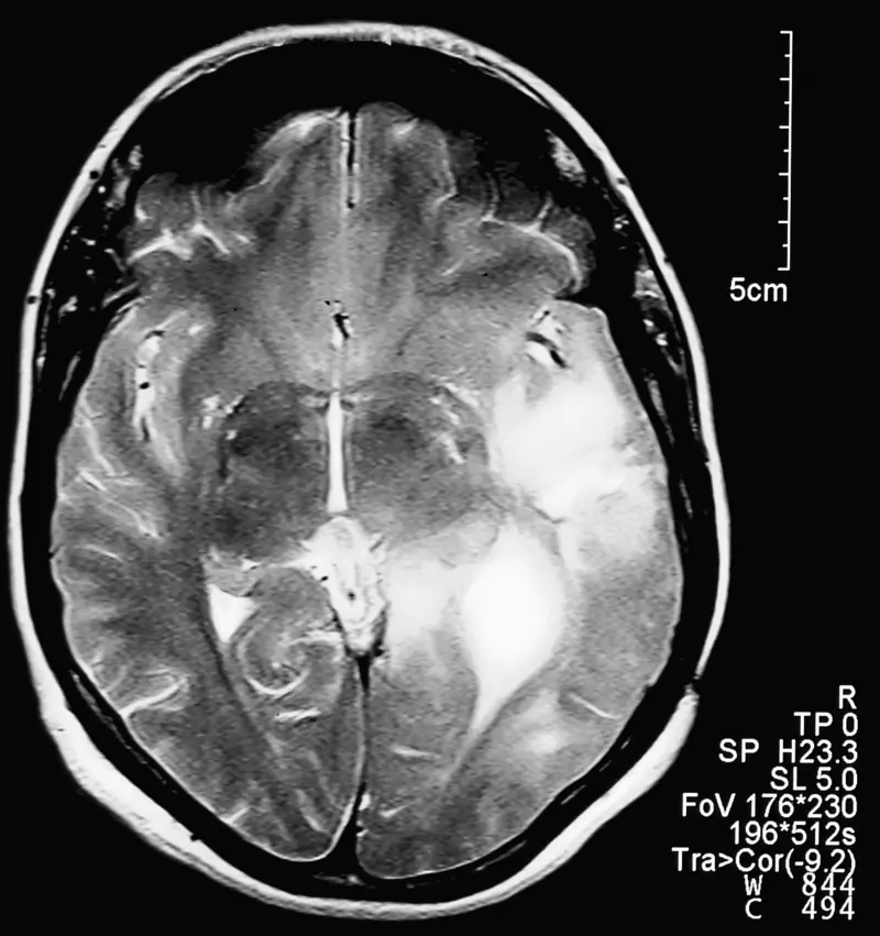 Brain with GBM (white areas) Brain with GBM (white areas)