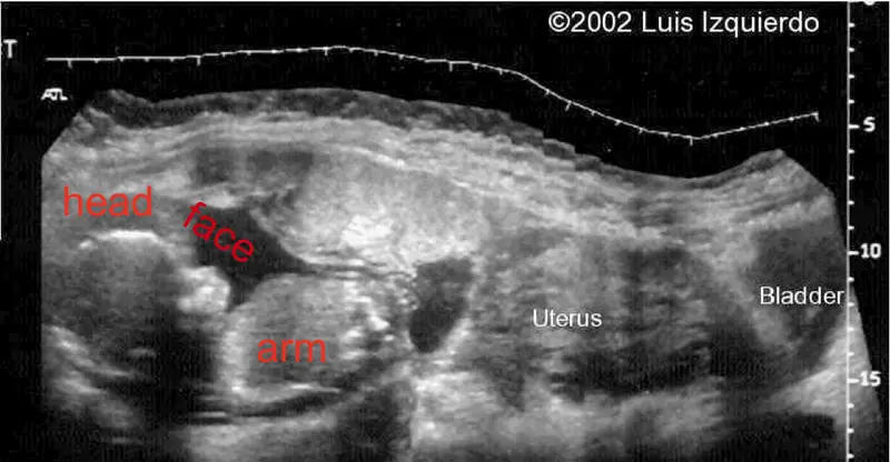 abdominal pregnancy