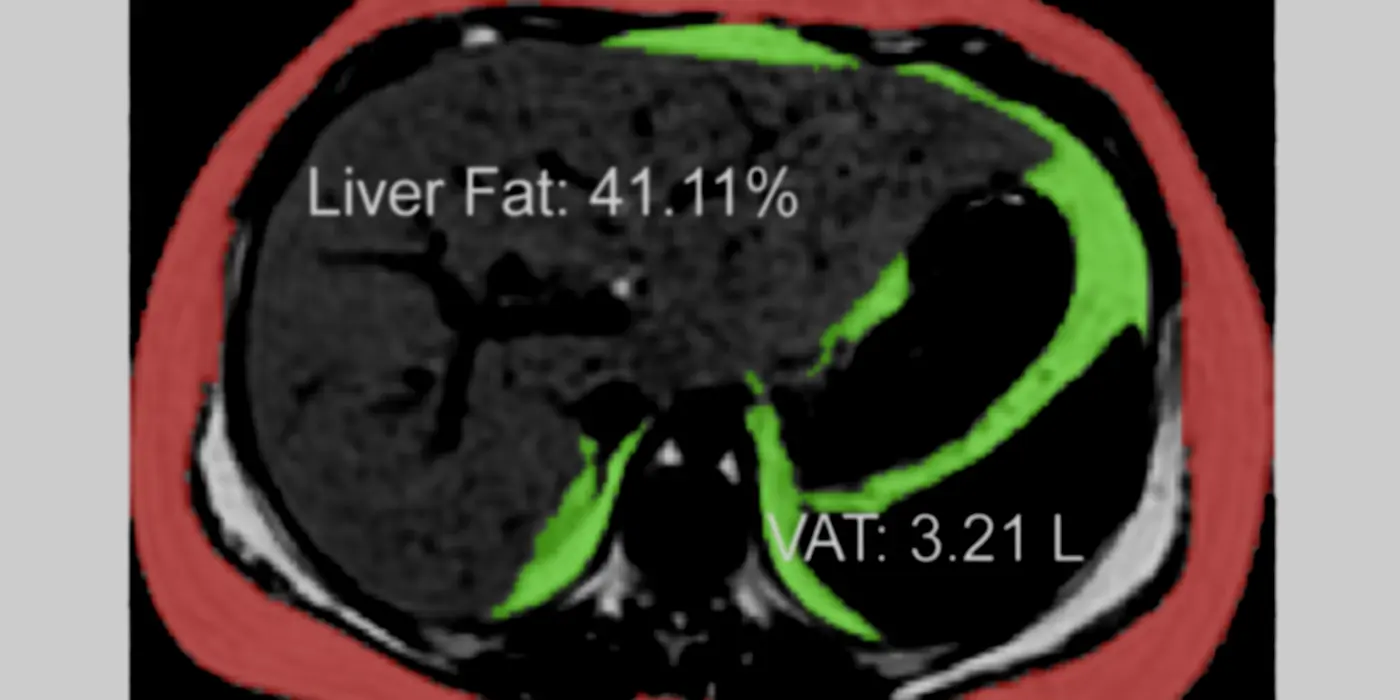 High Fructose Corn Syrup, Genes And Global Trade Policy:  A “Perfect Storm” For Fatty Liver Disease In Hispanics