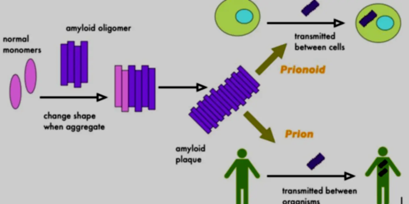 Alzheimer’s – Infectious Or Infection?
