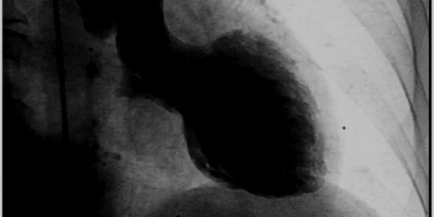 Tako-Tsubo: Can We Diagnose And Treat True Heartbreak?