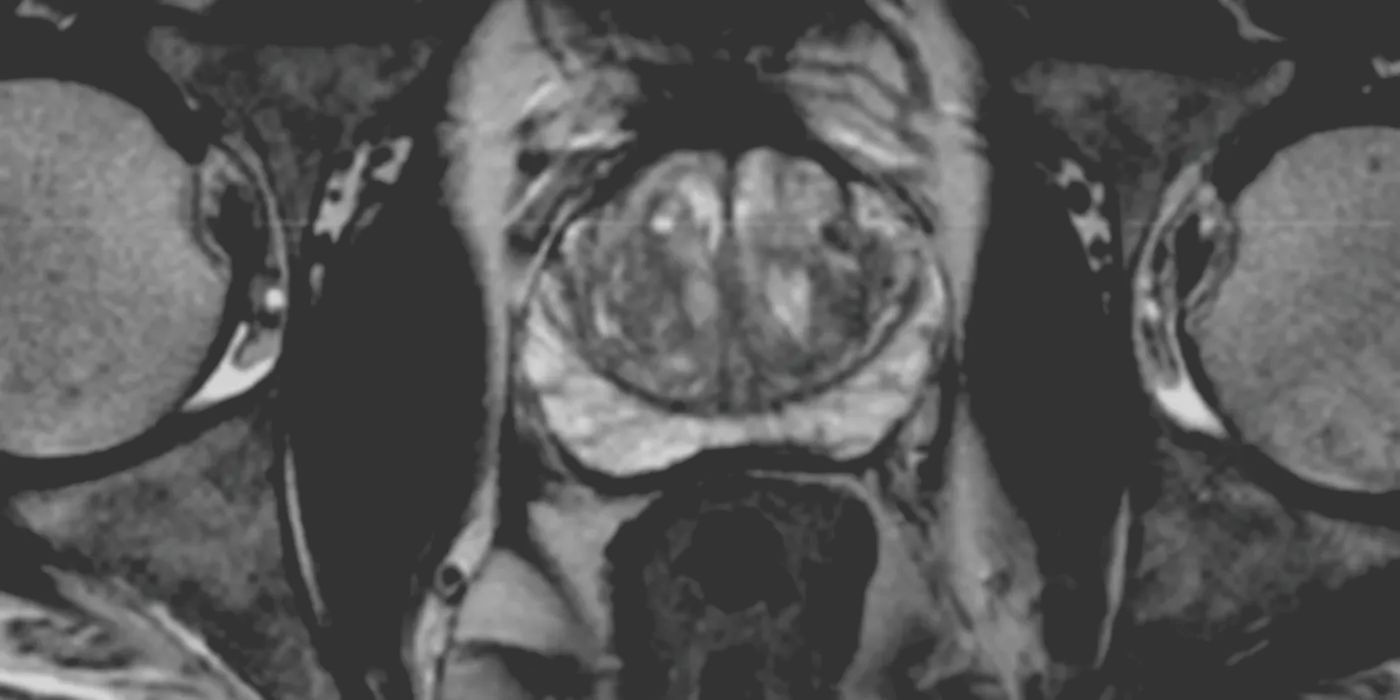 Major Increase In MRI Before Prostate Biopsy - Is It Necessary?