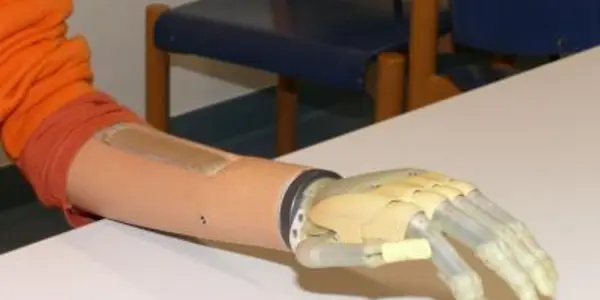 It's i-LIMB Versus Fluidhand For The Prosthetic Hand World Title