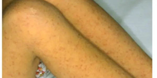 Small Ticks, Big Diseases