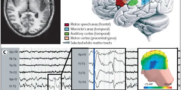 The Woman Who Heard Voices In Her Head - With Her Speech Impairments