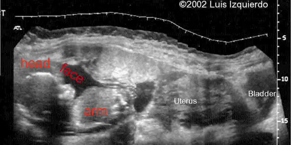 Can A Man Really Get Pregnant?  Sure, But It Might Kill Him
