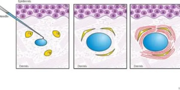 Shock - Some Collagen Repair Skin Treatments Actually Work