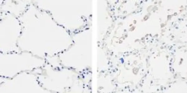 Mechanism of SARS Lung Damage