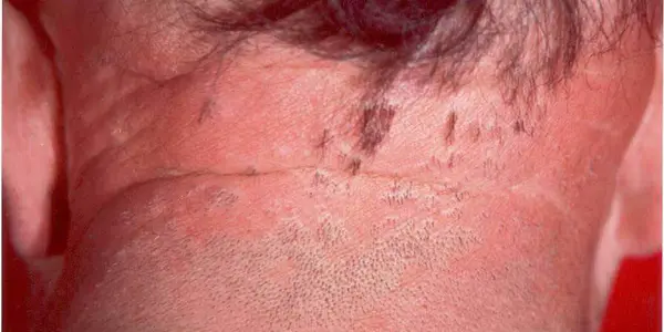 Lassueur Piccardi Graham Little Syndrome
