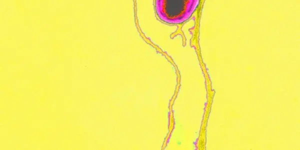 Defining DNA Differences Tackles Typhoid Fever