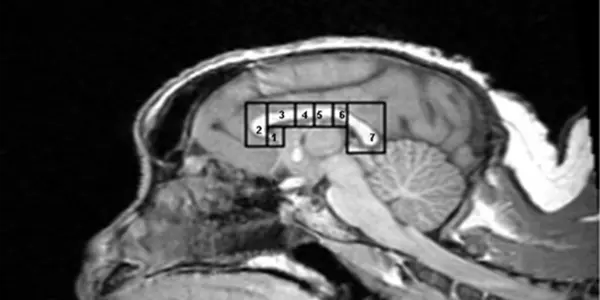 Corpus Callosum Similar In Capuchin Monkeys And Humans