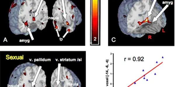 Sexual Image And Drug Craving Signals Linked In Brain Imaging Study