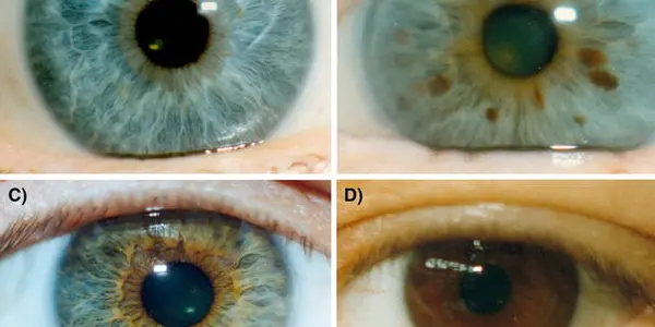 Blue-Eyed People Have One Common Ancestor