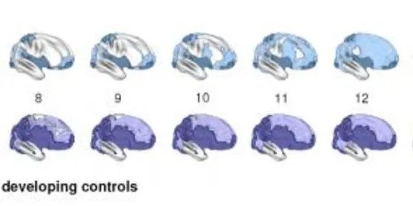 In ADHD, The Brain Matures Late But Follows Normal Pattern
