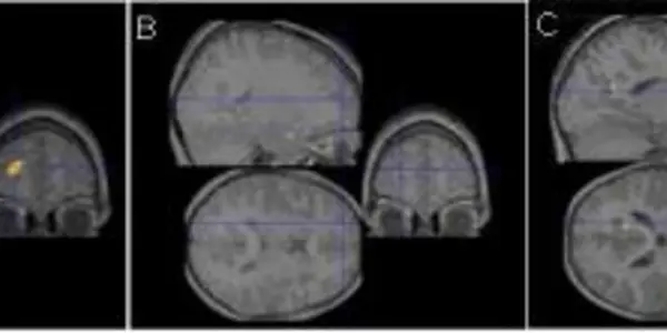 Dyslexia: Re-wiring The Brain Through Sound