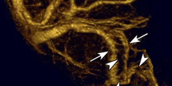 Combined Imaging Approach May Provide Better Identification of Difficult-to-Diagnose Brain Clots