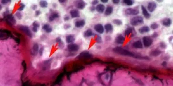 Born To Break: Mutation Causes Fragile Bones