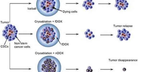 Cryoablation Plus Nanoparticle-Encapsulated Chemo Makes Cancer Go Boom