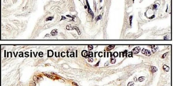 Putting A Brake On Tumor Spread