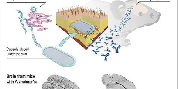 An Implant To Prevent Alzheimer's
