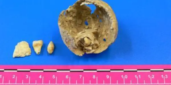 Ancient Roman Skeleton Contains Ovarian Tumor - With Teeth And Bone Fragment Inside