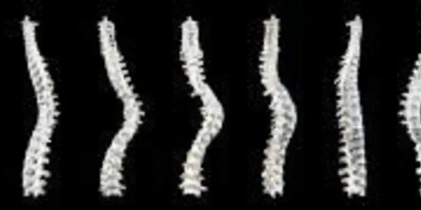 The 'Spiral Nature' Of Richard III's Scoliosis