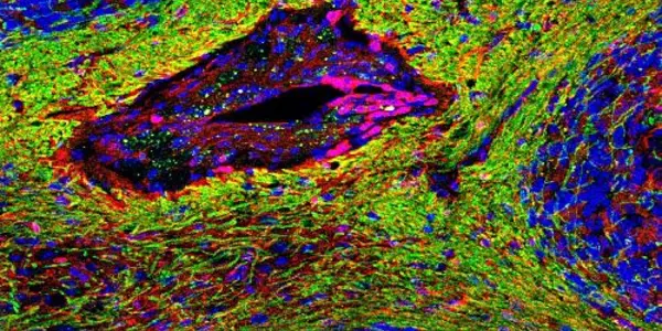 Brain Cell Death Is A Possible Trigger Of Multiple Sclerosis