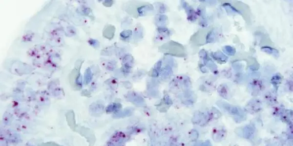 A Key Gene In The Development Of Celiac Disease Has Been Found In 'junk' DNA