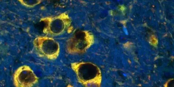 The Connection Between Excess Iron And Parkinson's Disease