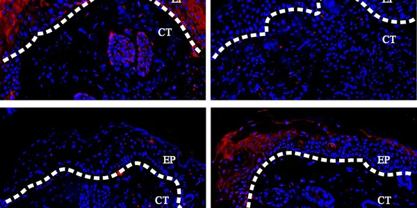 How FOXO1 Protein Slows Diabetic Wound Healing