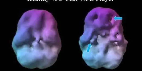 Abnormally Low Blood Flow Indicates Damage To NFL Players' Brains