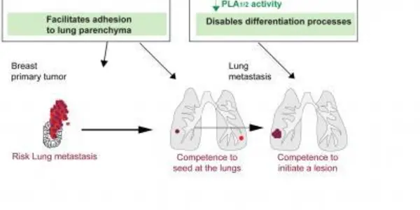 Researchers Identify A New Suppressor Of Breast Metastasis To The Lung