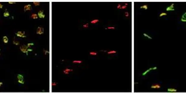 Study Identifies Gene Tied To Motor Neuron Loss In ALS