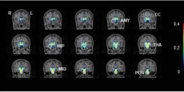Toward A Clearer Diagnosis Of Chronic Fatigue Syndrome