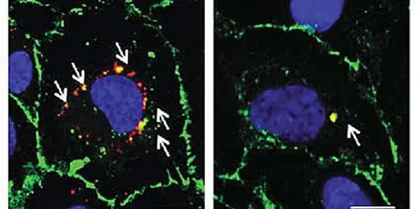 Statins May Lower Risk Of Heart Disease In People With Sleep Apnea