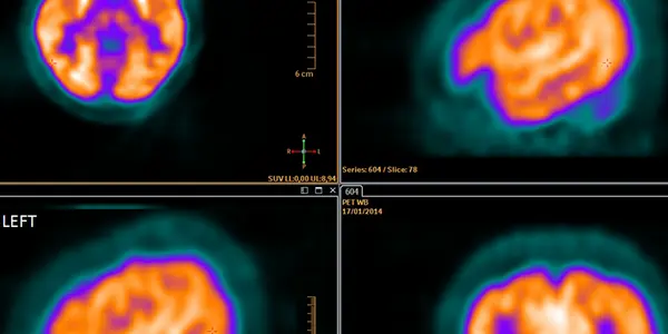 FDG PET-CT In Clinical Decision-Making