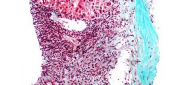 Biomarkers Identify Liver Cancer Progenitor Cells Before Tumors Become Visible