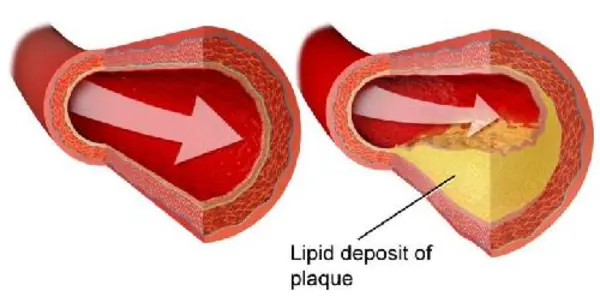 Beer Is The New Wine: Flavonoid In Hops Lowers Cholesterol, Blood Sugar And Weight Gain