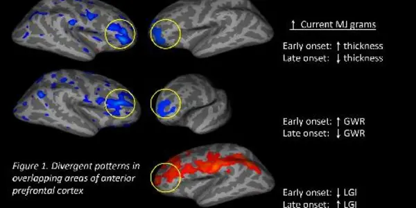 Starting Age Of Marijuana Use May Have Long-term Effects On Brain Development