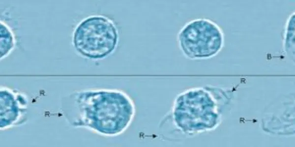 Necrotizing Enterocolitis: In Vitro Study Finds Digested Formula Is Toxic To Cells But Breast Milk Isn't