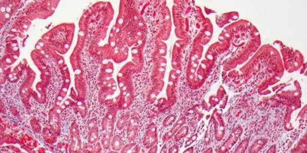 Celiac Disease Patients Have Higher Lymphoma Risk
