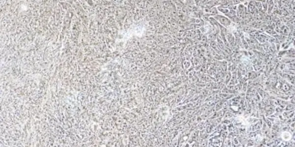 Omega-3 Fatty Acids Could Aid Skin And Oral Cancer Treatment