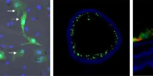 Using Nanoparticles To Combat Arteriosclerosis