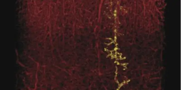 To The Brain, There Is No Such Thing As A Small Stroke - But An Approved Drug Helps