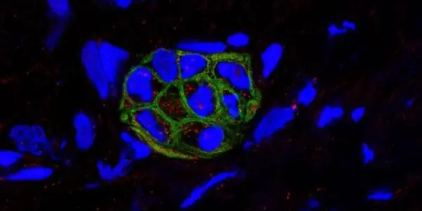 Cell Death Mechanism May -- Paradoxically -- Enable Aggressive Pancreatic Cells To Live On