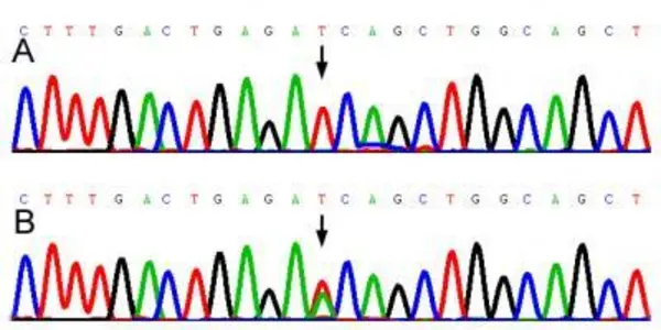 Genetic Background Of Sporadic Amyotrophic Lateral Sclerosis In The Chinese Han Population